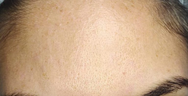 acne prima e dopo