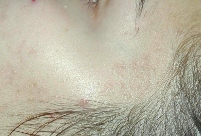 acne prima e dopo