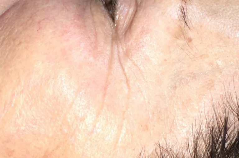 cura delle rughe prima e dopo